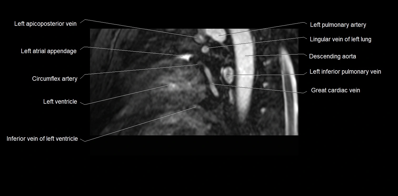 MRI heart and coronary arteries two chamber(sagittal)  anatomy image 35.webp